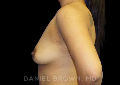 Breast Augmentation Before & After Patient #9039