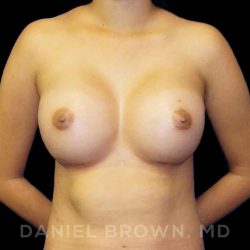Breast Augmentation Before & After Patient #9046