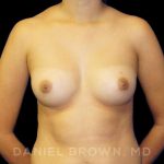 Breast Augmentation Before & After Patient #9046
