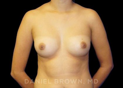 Breast Augmentation Before & After Patient #9046