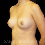 Breast Augmentation Before & After Patient #9046
