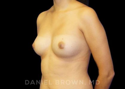 Breast Augmentation Before & After Patient #9046