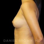 Breast Augmentation Before & After Patient #9046