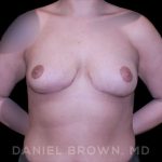 Bellesoma Breast Lift Before & After Patient #8408