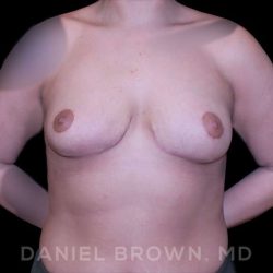 Bellesoma Breast Lift Before & After Patient #8408
