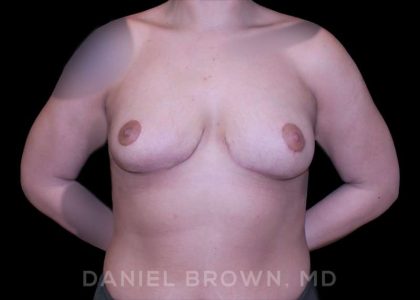 Bellesoma Breast Lift Before & After Patient #8408