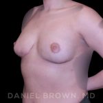 Bellesoma Breast Lift Before & After Patient #8408