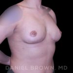 Bellesoma Breast Lift Before & After Patient #8408