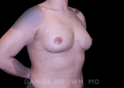 Bellesoma Breast Lift Before & After Patient #8408