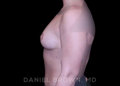 Bellesoma Breast Lift Before & After Patient #8408