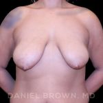 Bellesoma Breast Lift Before & After Patient #8408