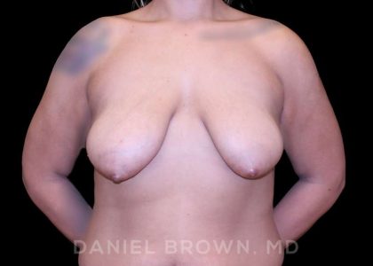 Bellesoma Breast Lift Before & After Patient #8408