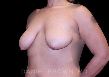 Bellesoma Breast Lift Before & After Patient #8408