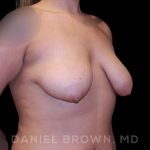 Bellesoma Breast Lift Before & After Patient #8408