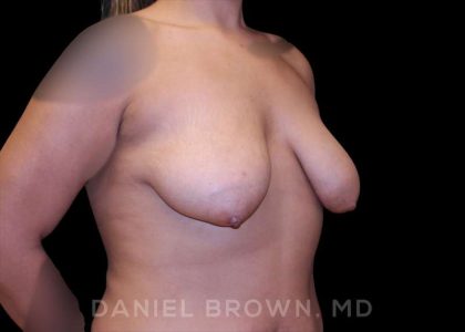 Bellesoma Breast Lift Before & After Patient #8408