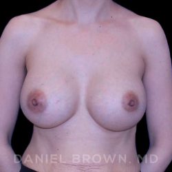 Breast Augmentation Before & After Patient #9053
