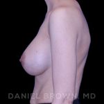 Breast Augmentation Before & After Patient #9053