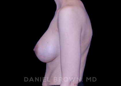 Breast Augmentation Before & After Patient #9053
