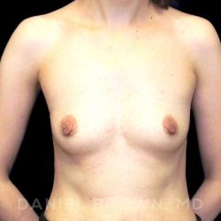 Breast Augmentation Before & After Patient #9053