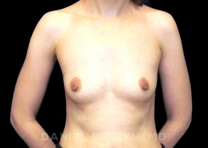 Breast Augmentation Before & After Patient #9053