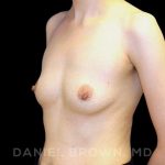 Breast Augmentation Before & After Patient #9053
