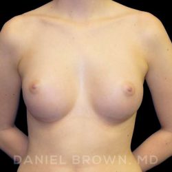 Breast Augmentation Before & After Patient #9060