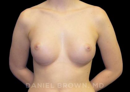 Breast Augmentation Before & After Patient #9060