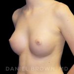 Breast Augmentation Before & After Patient #9060