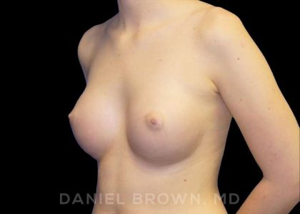 Breast Augmentation Before & After Patient #9060