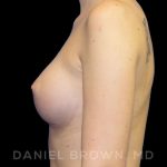 Breast Augmentation Before & After Patient #9060