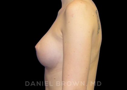 Breast Augmentation Before & After Patient #9060
