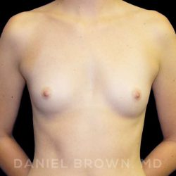 Breast Augmentation Before & After Patient #9060