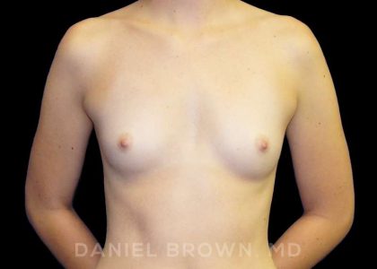 Breast Augmentation Before & After Patient #9060