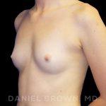 Breast Augmentation Before & After Patient #9060