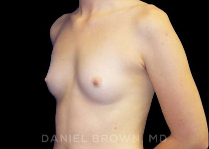 Breast Augmentation Before & After Patient #9060