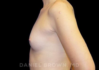 Breast Augmentation Before & After Patient #9060