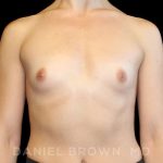 Breast Augmentation Before & After Patient #9071
