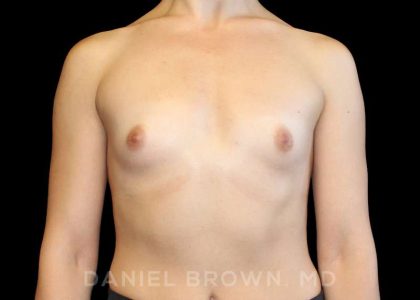 Breast Augmentation Before & After Patient #9071