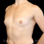 Breast Augmentation Before & After Patient #9071