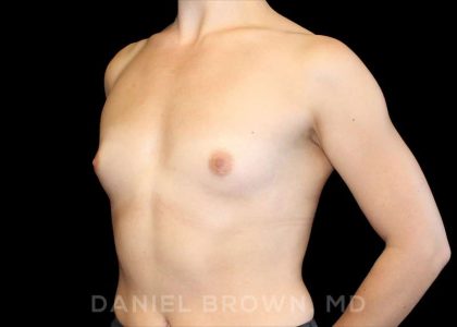 Breast Augmentation Before & After Patient #9071