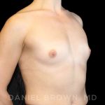 Breast Augmentation Before & After Patient #9071