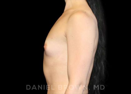 Breast Augmentation Before & After Patient #9071