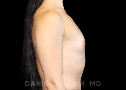 Breast Augmentation Before & After Patient #9071