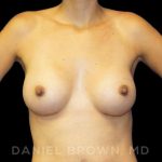 Breast Augmentation Before & After Patient #9078
