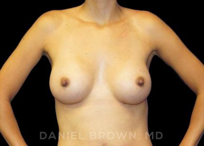 Breast Augmentation Before & After Patient #9078