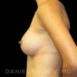 Breast Augmentation Before & After Patient #9078