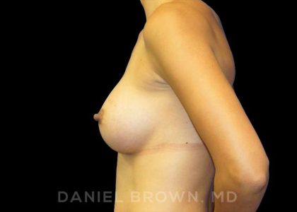Breast Augmentation Before & After Patient #9078