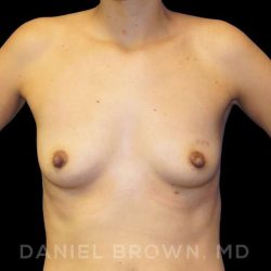 Breast Augmentation Before & After Patient #9078