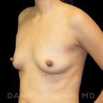 Breast Augmentation Before & After Patient #9078