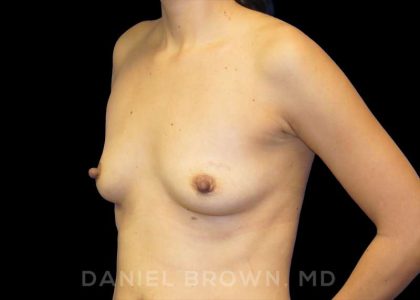 Breast Augmentation Before & After Patient #9078